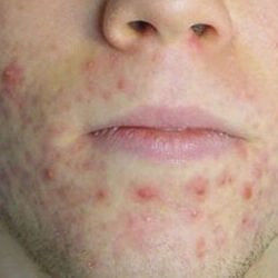 Example of acne